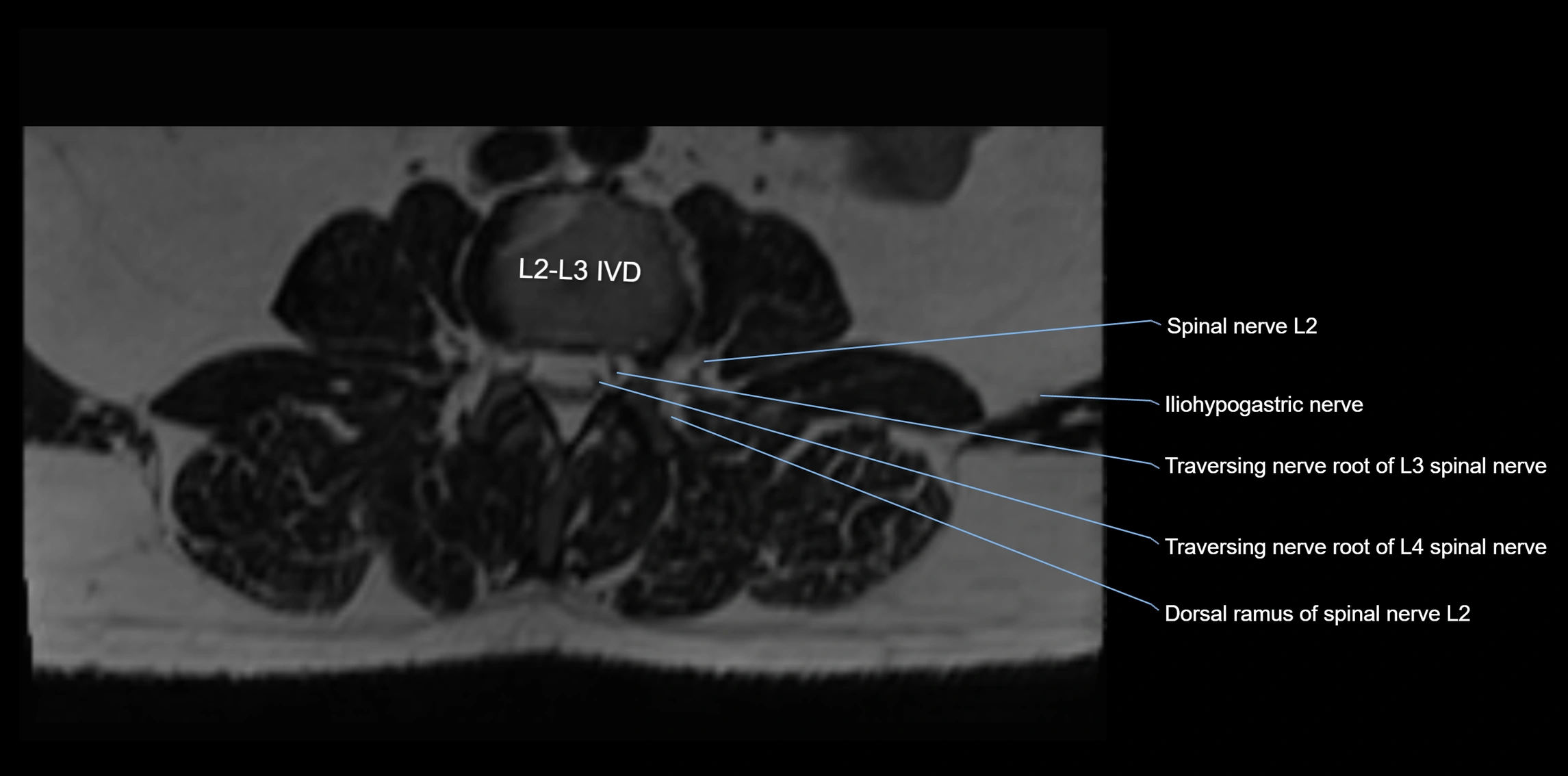 MR lumbosacral plexus axial cross sectional anatomy 3T  radiology  image-img-1008001-00015.webp